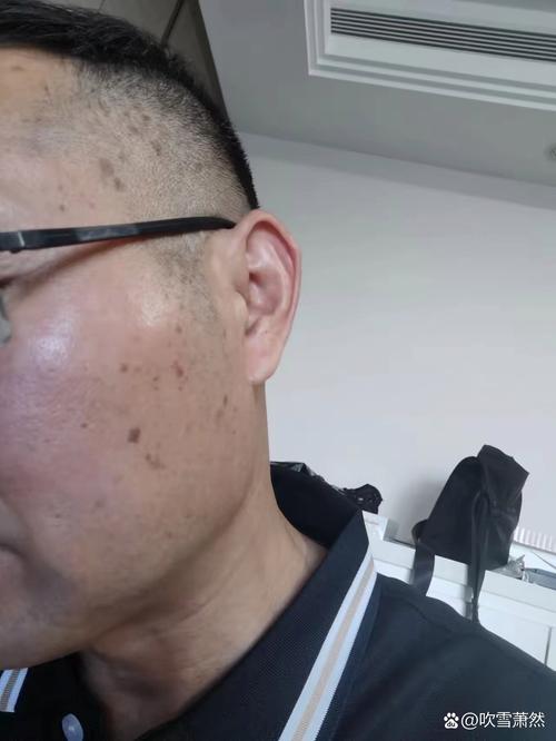 老年斑是什么样子