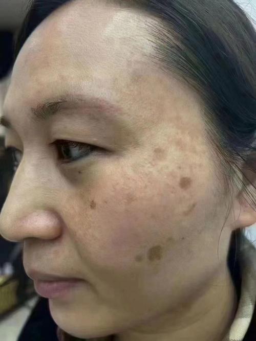 老年斑是什么样子
