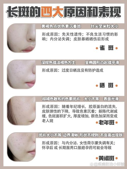 脸上为什么会长黑斑