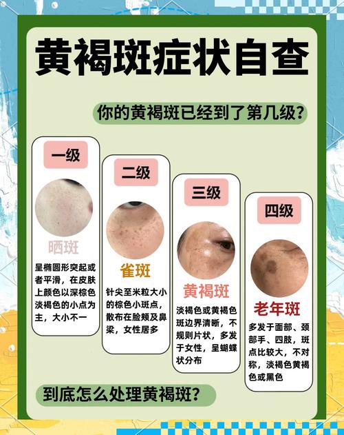 脸上为什么会长黑斑