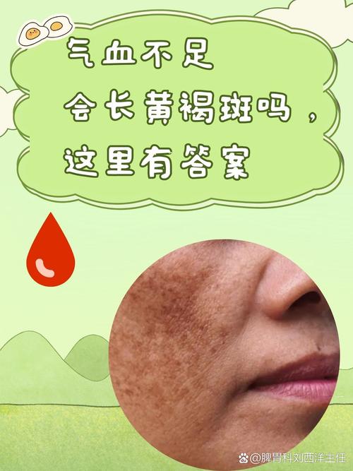 脸上为什么会长黑斑