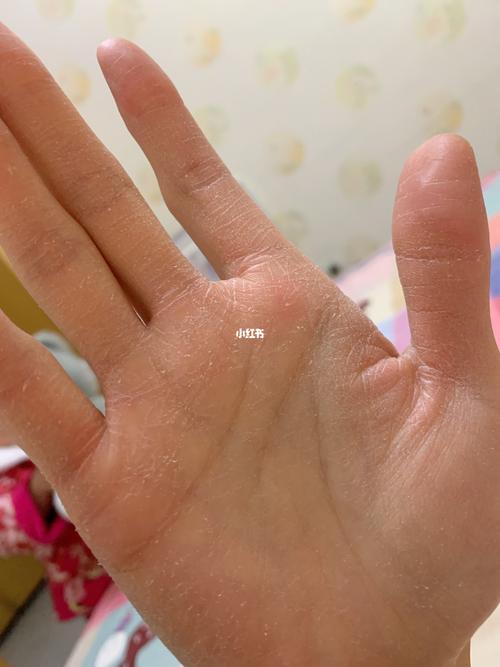 手心粗糙是什么原因