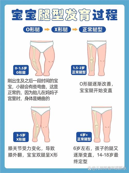 什么是o型腿图片
