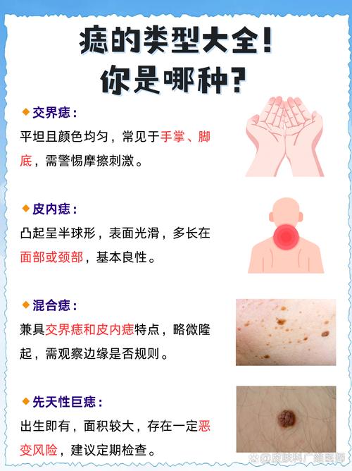 为什么后天会长痣