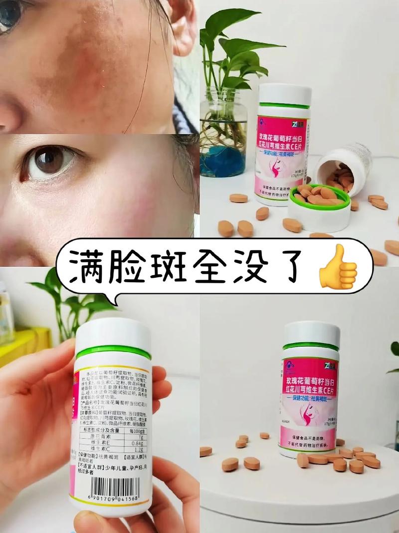吃什么能去脸上的斑