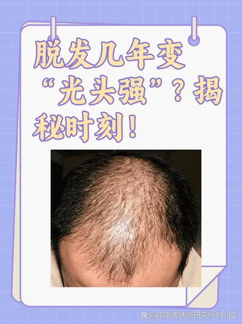 为什么脱发很厉害