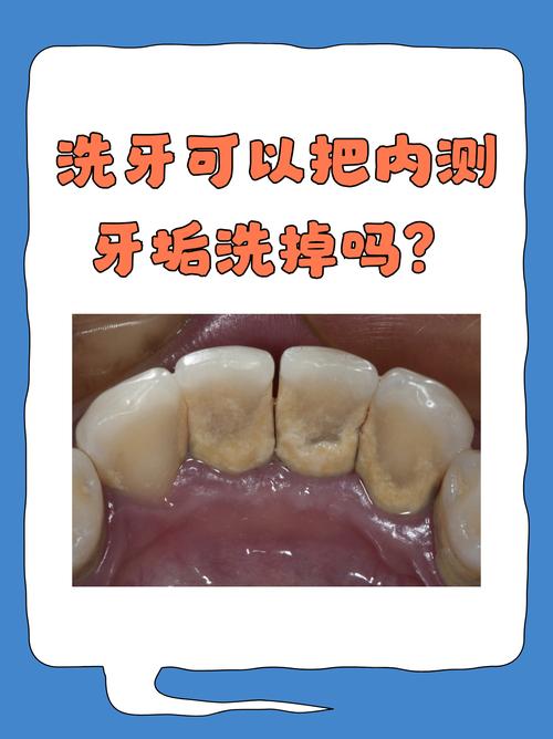 洗牙能洗掉什么