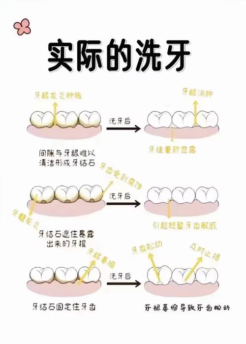 洗牙能洗掉什么