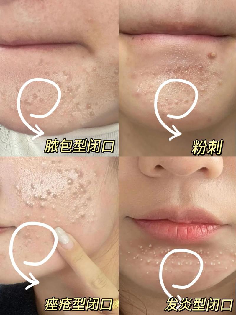脸上闭口什么意思