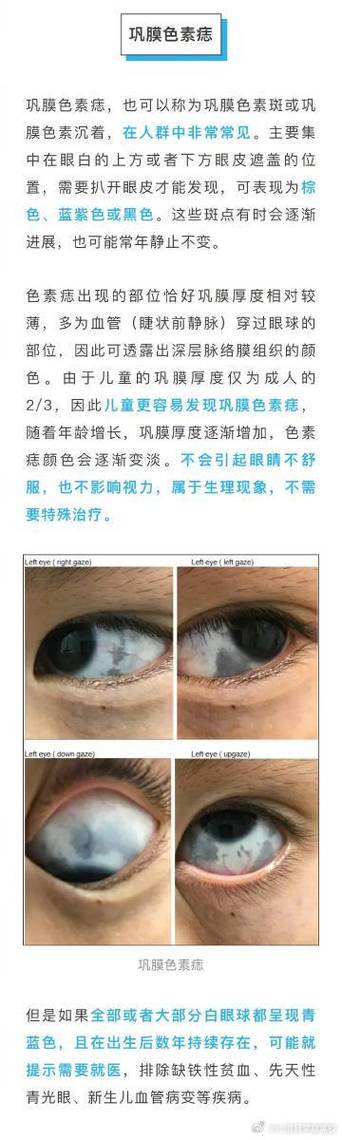 眼皮白色斑块是什么