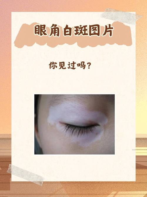 眼皮白色斑块是什么