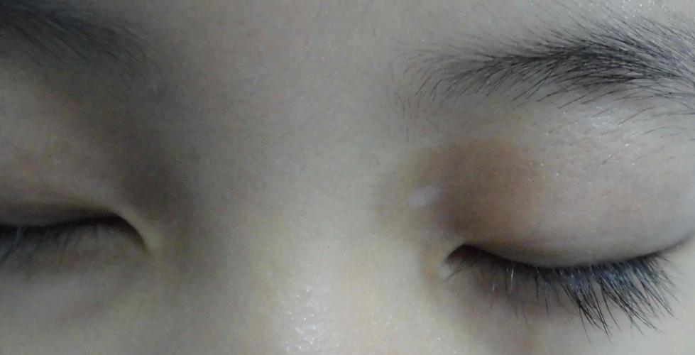 眼皮白色斑块是什么