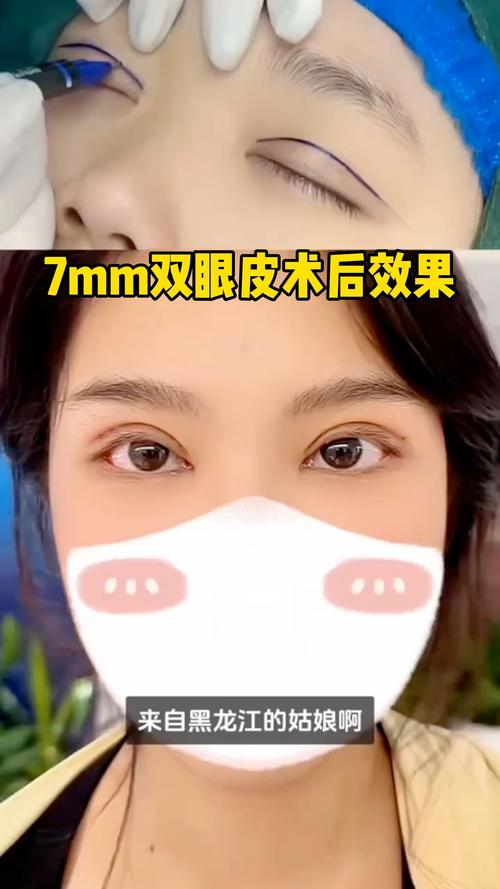 什么是微创双眼皮