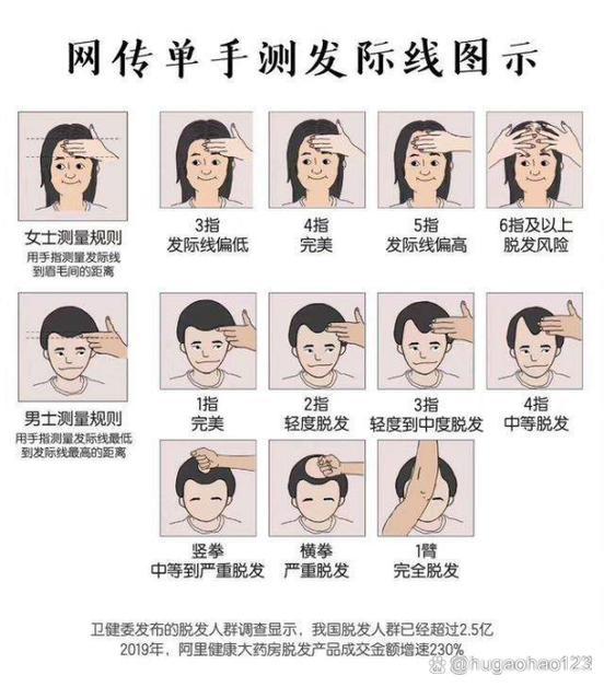 发际线为什么会变高