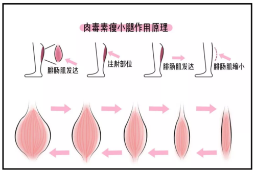 瘦腿针是什么原理