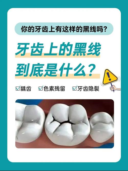 牙上的黑线是什么