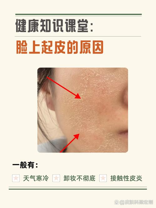 为什么脸上老是起皮