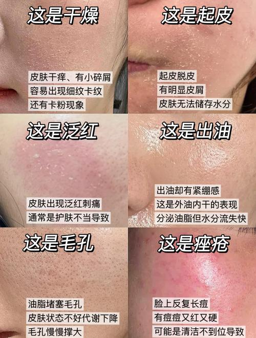 为什么脸上老是起皮