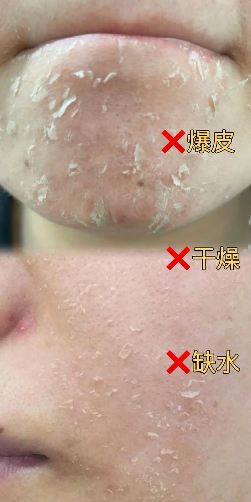 为什么脸上老是起皮