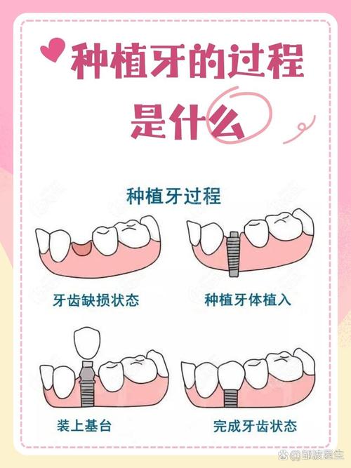 种植牙需要什么条件