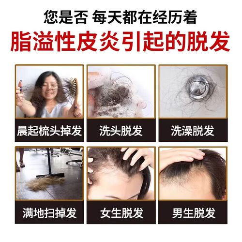 脂溢性脱发吃什么好