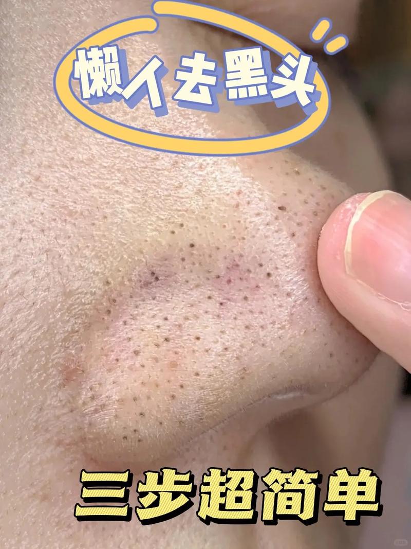 有什么去黑头
