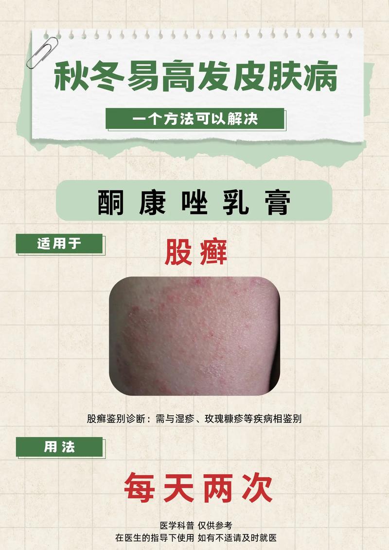 股癣有什么危害