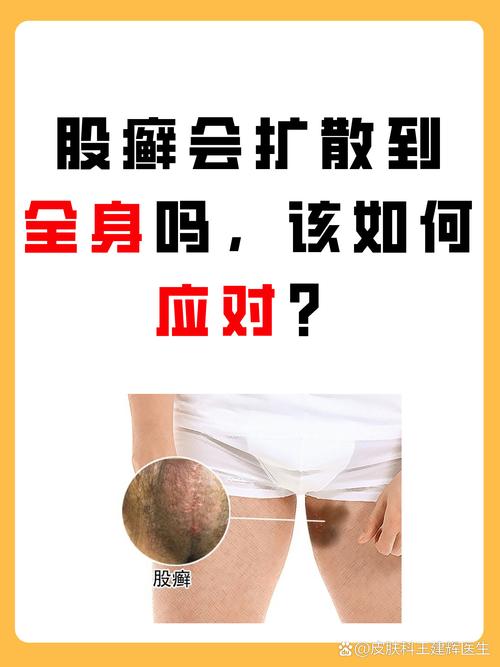 股癣有什么危害