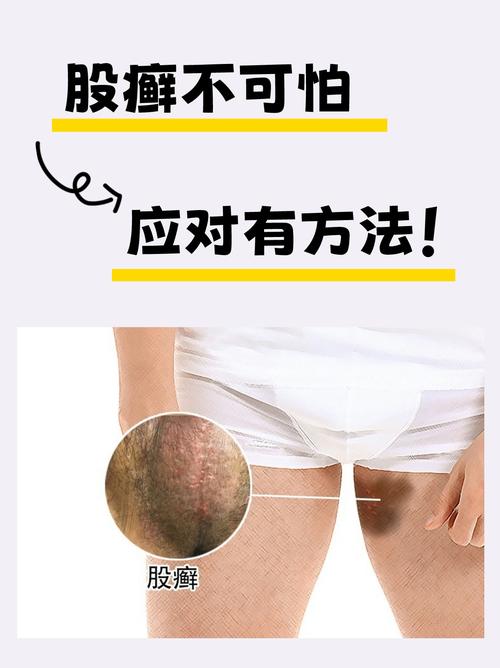 股癣有什么危害