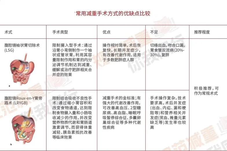 最好手术减肥方法是什么