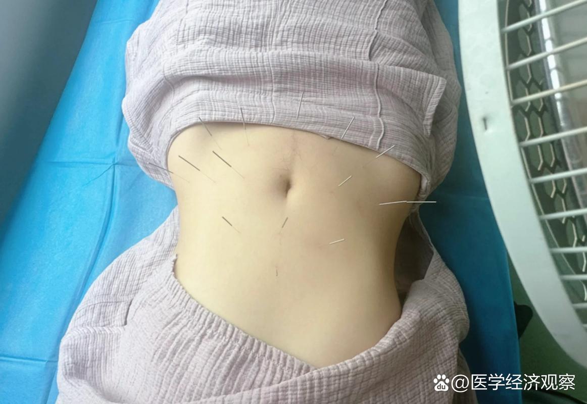 什么医院针灸减肥