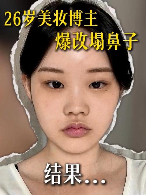 塌鼻子是什么样的