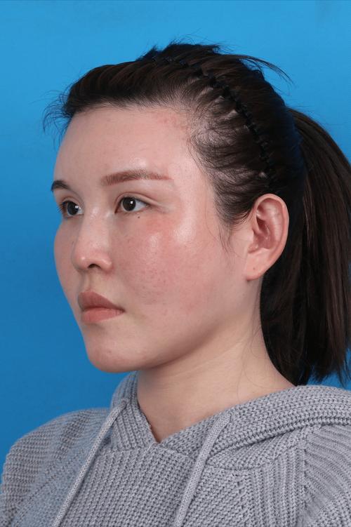 塌鼻子是什么样的