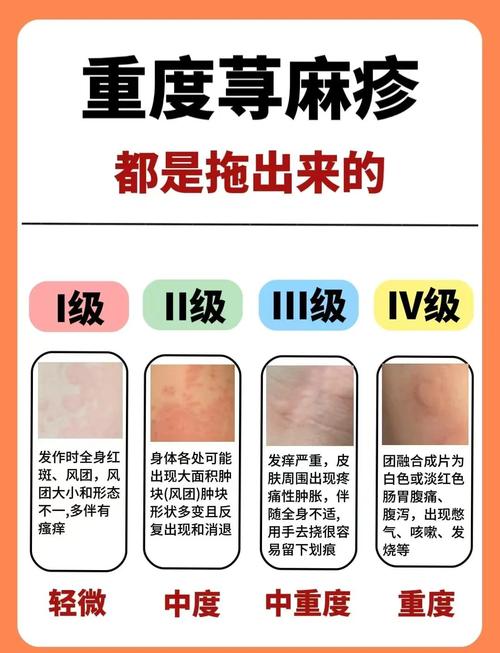 得荨麻疹是什么原因