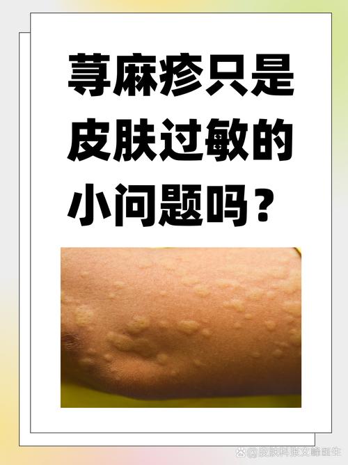 得荨麻疹是什么原因