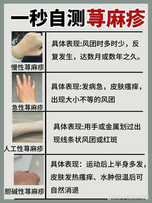 得荨麻疹是什么原因