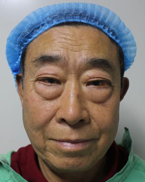 眼袋为什么越来越大