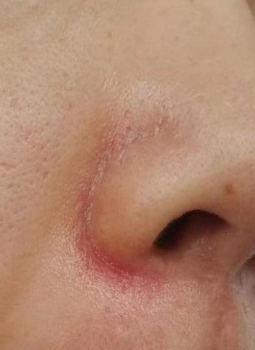 为什么鼻翼两侧发红