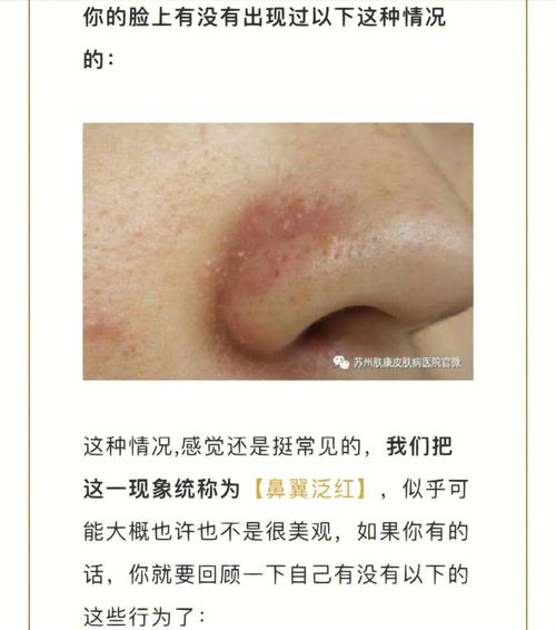 为什么鼻翼两侧发红