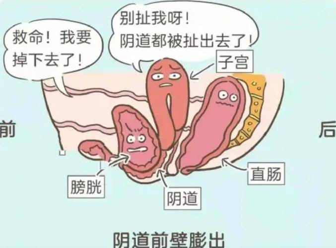 阴道松弛是什么原因