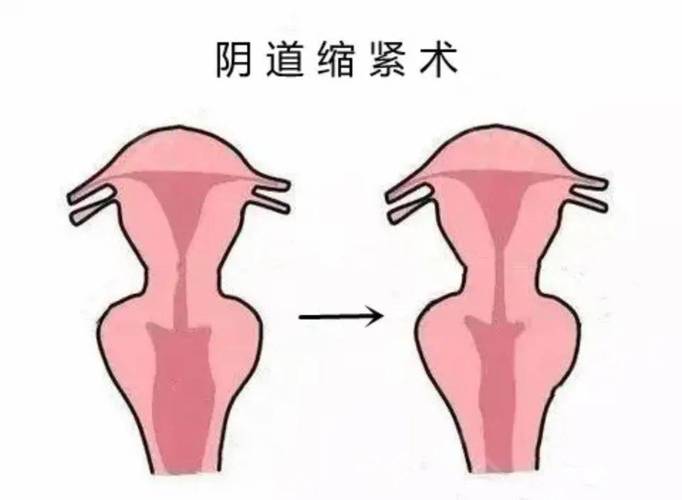 阴道松弛是什么原因