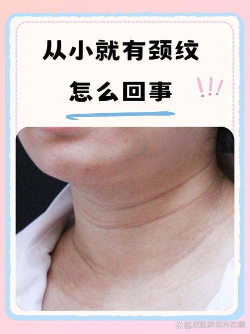为什么脖子会有颈纹