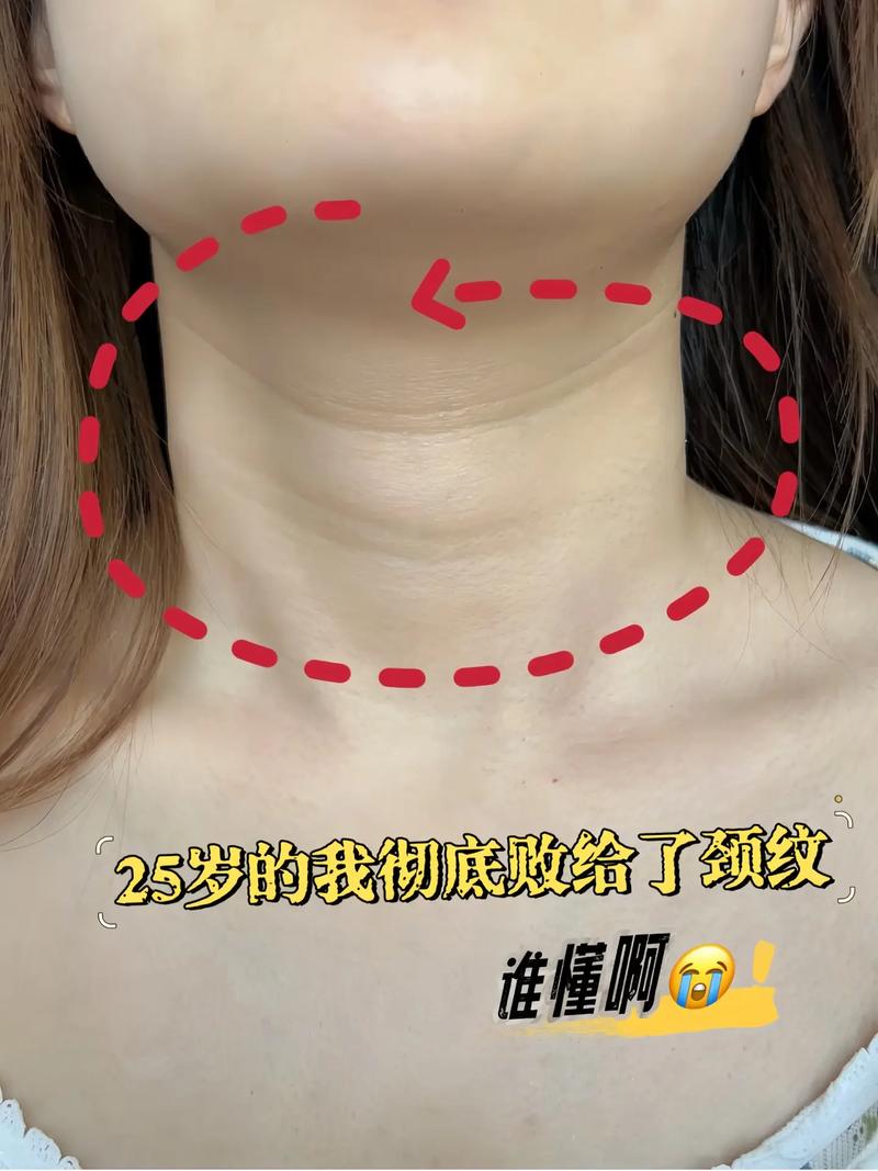 为什么脖子会有颈纹