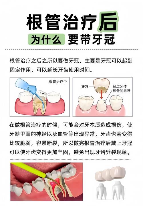 什么牙齿需要根管治疗