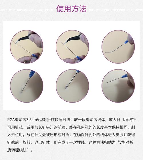 埋线减肥用什么线