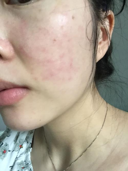 面膜过敏是什么症状