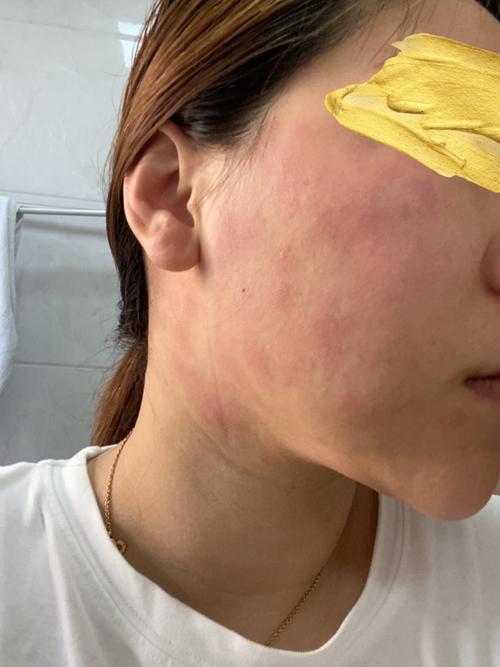 面膜过敏是什么症状