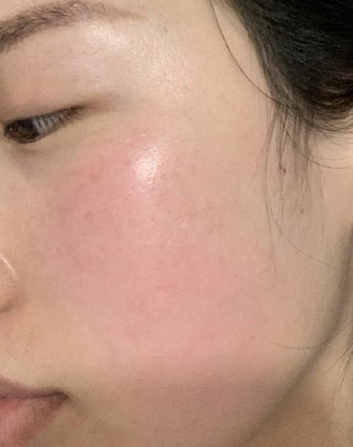 面膜过敏是什么症状