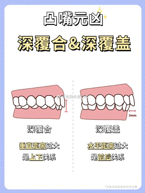 什么是深覆盖