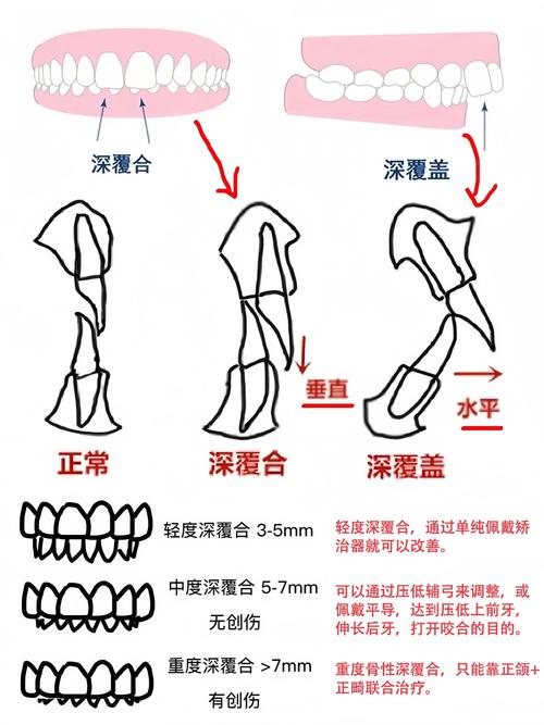 什么是深覆盖